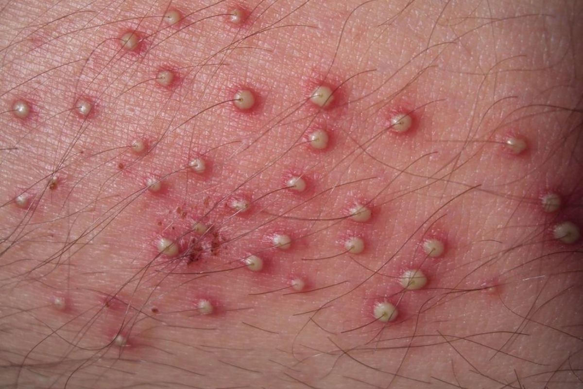 Nguyên nhân và cách xử lý viêm nang lông vùng kín nam giới