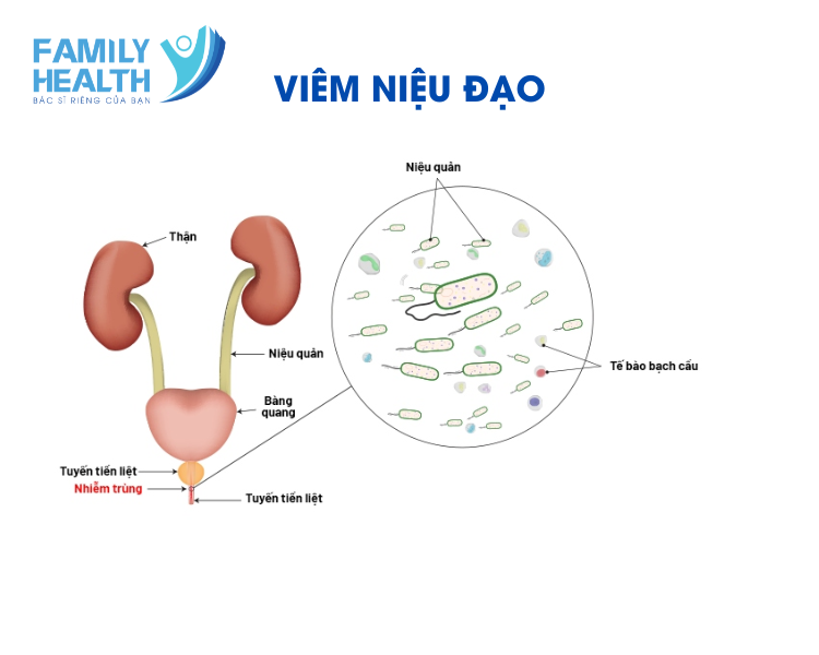 VIÊM NIỆU ĐẠO Ở NAM GIỚI: TRIỆU CHỨNG, NGUYÊN NHÂN, ĐIỆU TRỊ VÀ PHÒNG NGỪA